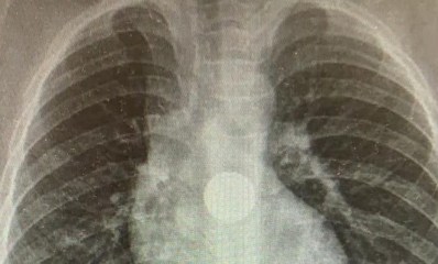 סוללת הדיסק בבטנה של הילדה. חייה ניצלו. צילומים: דוברות בית החולים מאיר