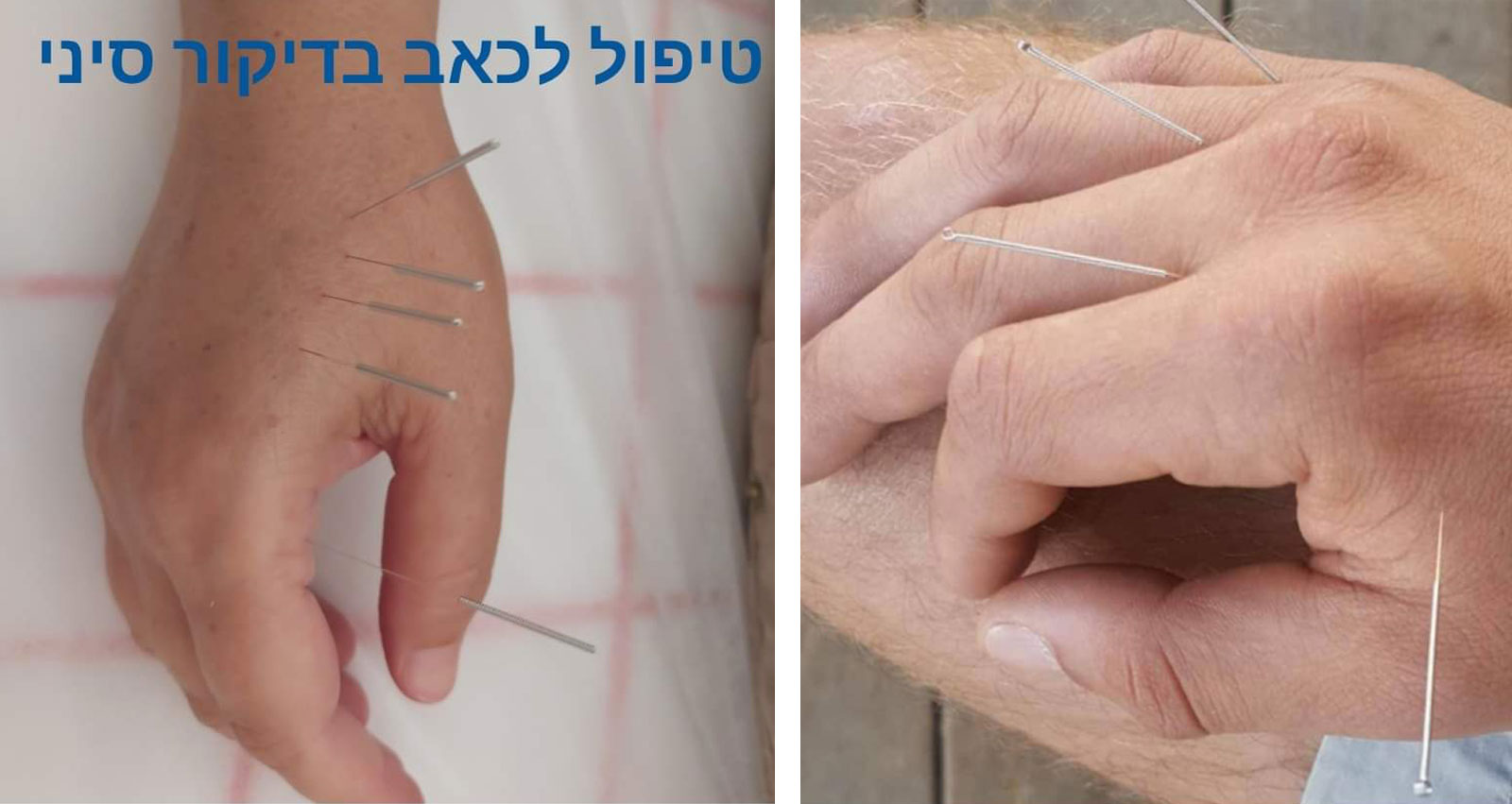 דיקור סיני. צילום: פרטי