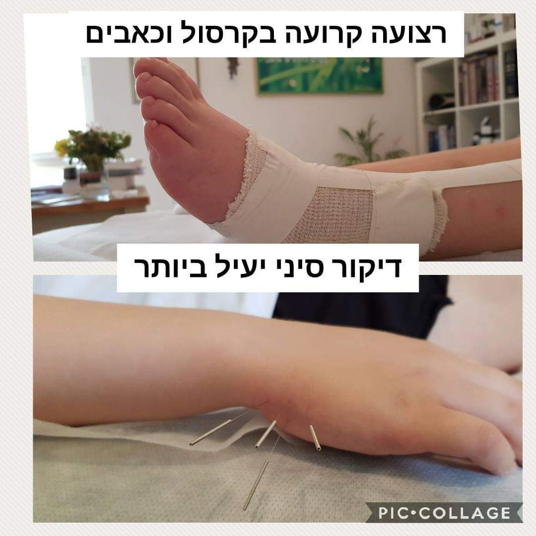 דיקור סיני. צילום: פרטי