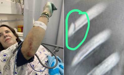 דנית ניצן באשפוז באיכילוב. מימין - צילום הרנטגן של הצלע השבורה. צילום: פרטי