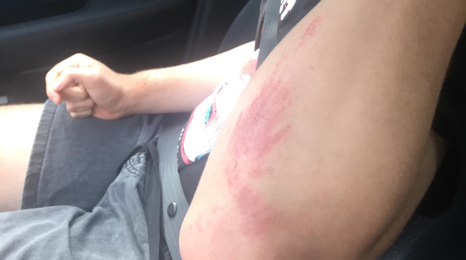 חבלה על היד. צילום: שרון מישקובסקי