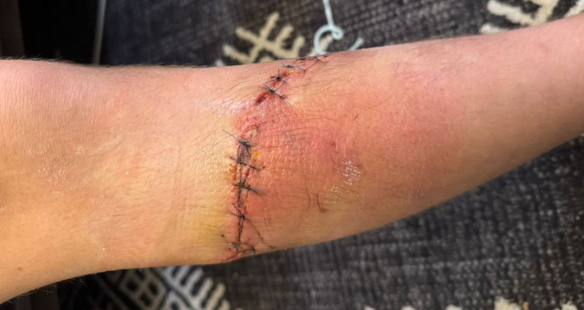 רגל של נער עם תפרים לאחר פציעה, צילום פרטי