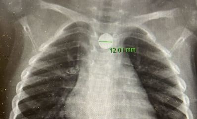 סוללת דיסק תקועה בוושט. צילום: דוברות מרכז רפואי מאיר מקבוצת כללית