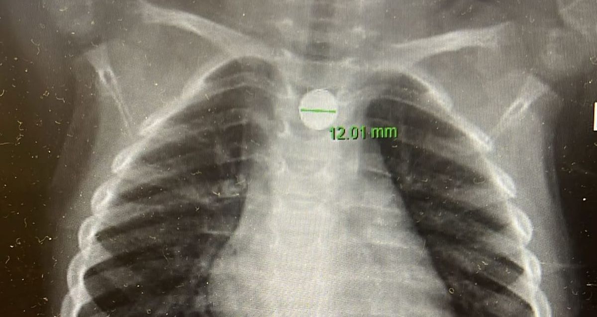 סוללת דיסק תקועה בוושט. צילום: דוברות מרכז רפואי מאיר מקבוצת כללית