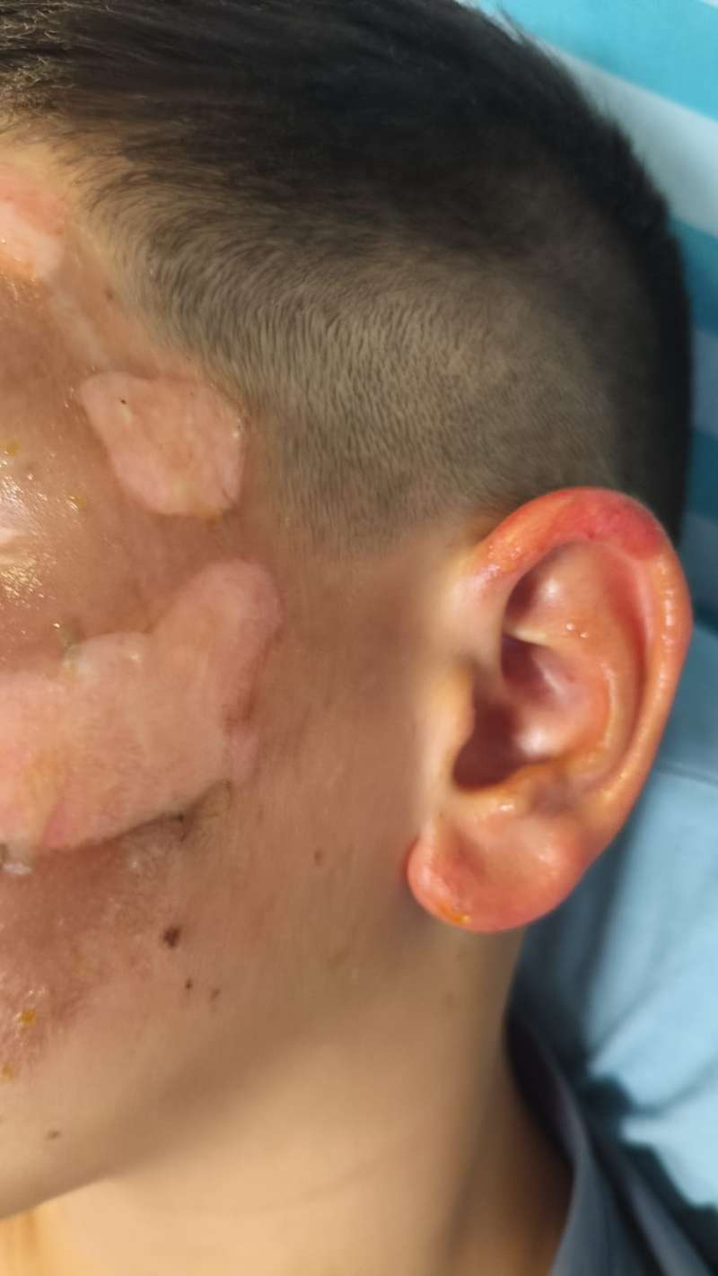 הילד הגיע עם כוויות בפנים ובידיים. צילום: המרכז הרפואי מאיר